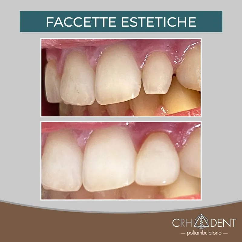 Risultato prima e dopo di faccette estetiche realizzate al centro dentale Crodent di Rho